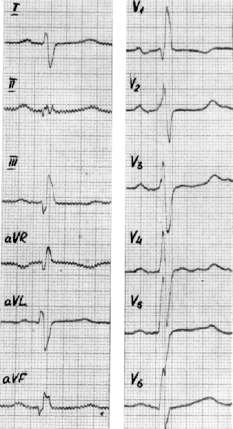 EKG hipertenzija 2 laipsniai