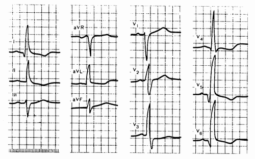 EKG širdies hipertenzija)