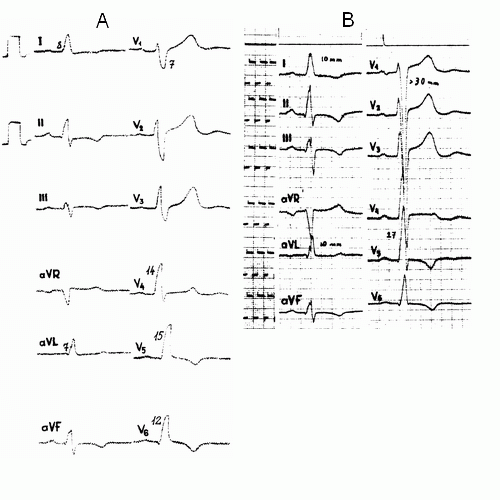 Hipertenzijos klasifikacija pagal etapus ir laipsnius: lentelė
