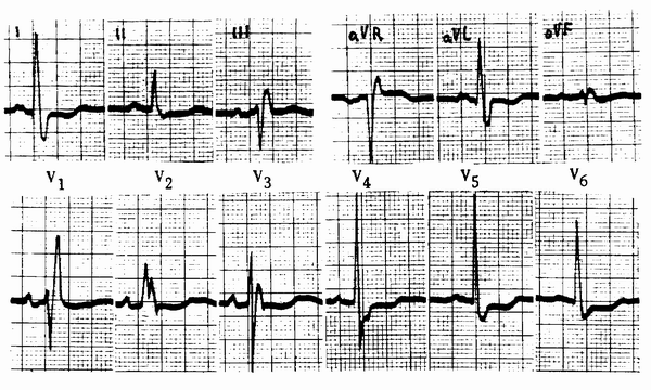EKG pokyčiai esant hipertenzijai