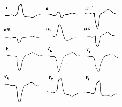 ką rodo EKG esant hipertenzijai