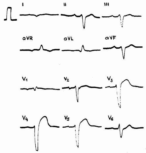 EKG rodo hipertenziją)